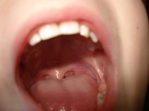 Come prevenire sette disturbi della bocca